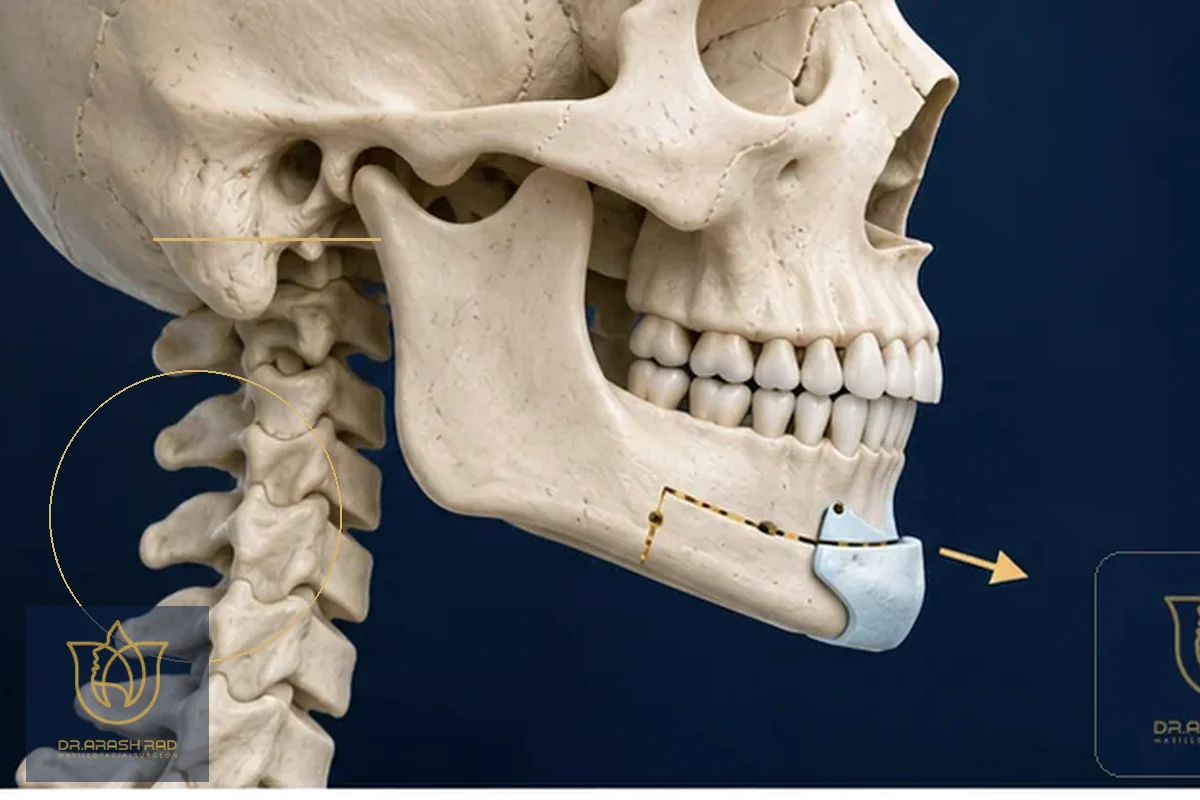 Chin Surgery in Tehran: Benefits, Costs, and What to Expect