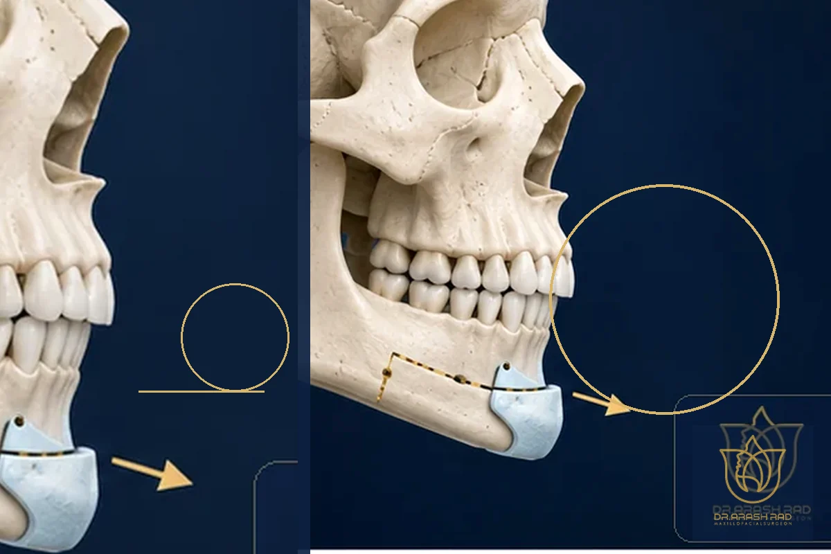 Double Chin Fat vs Sagging Skin: Which One Do You Have?