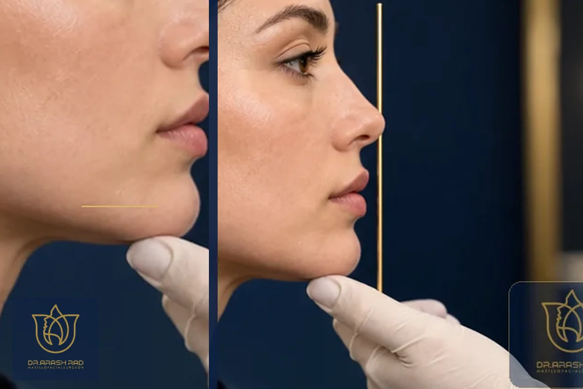 Chin Wing Osteotomy: How Mandibular Repositioning Redefines Facial Strength
