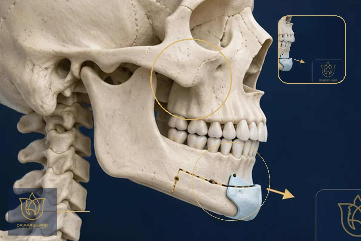 Receding Chin Surgery: 4 Expert Solutions for Jaw Harmony