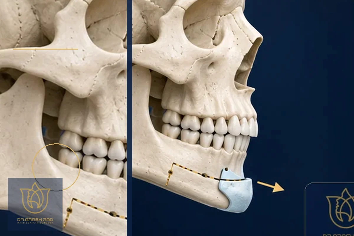 5 New Perspectives on Jawline Contour and Double Chin: Beyond Surgery