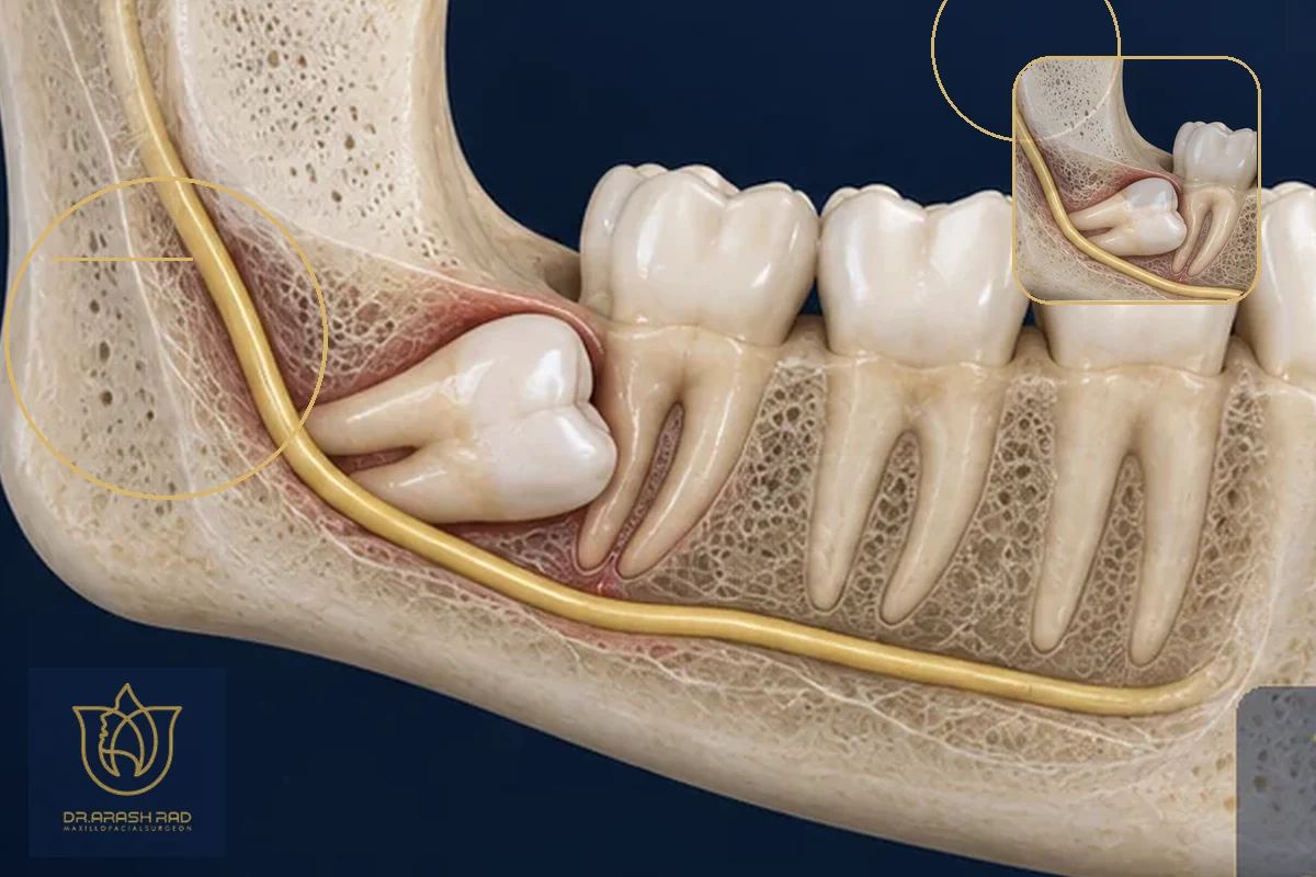 Impacted Canine Surgery: Assessment and Treatment