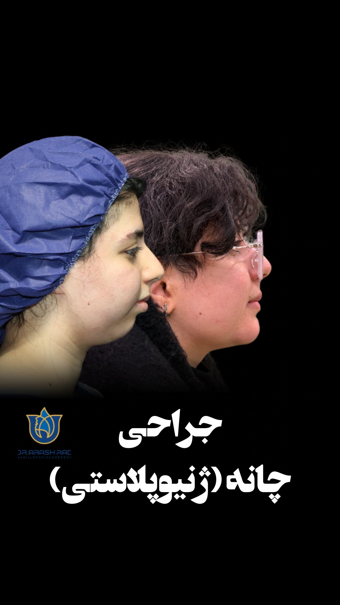 مقایسه نیمرخ پیش و پس از ژنیوپلاستی