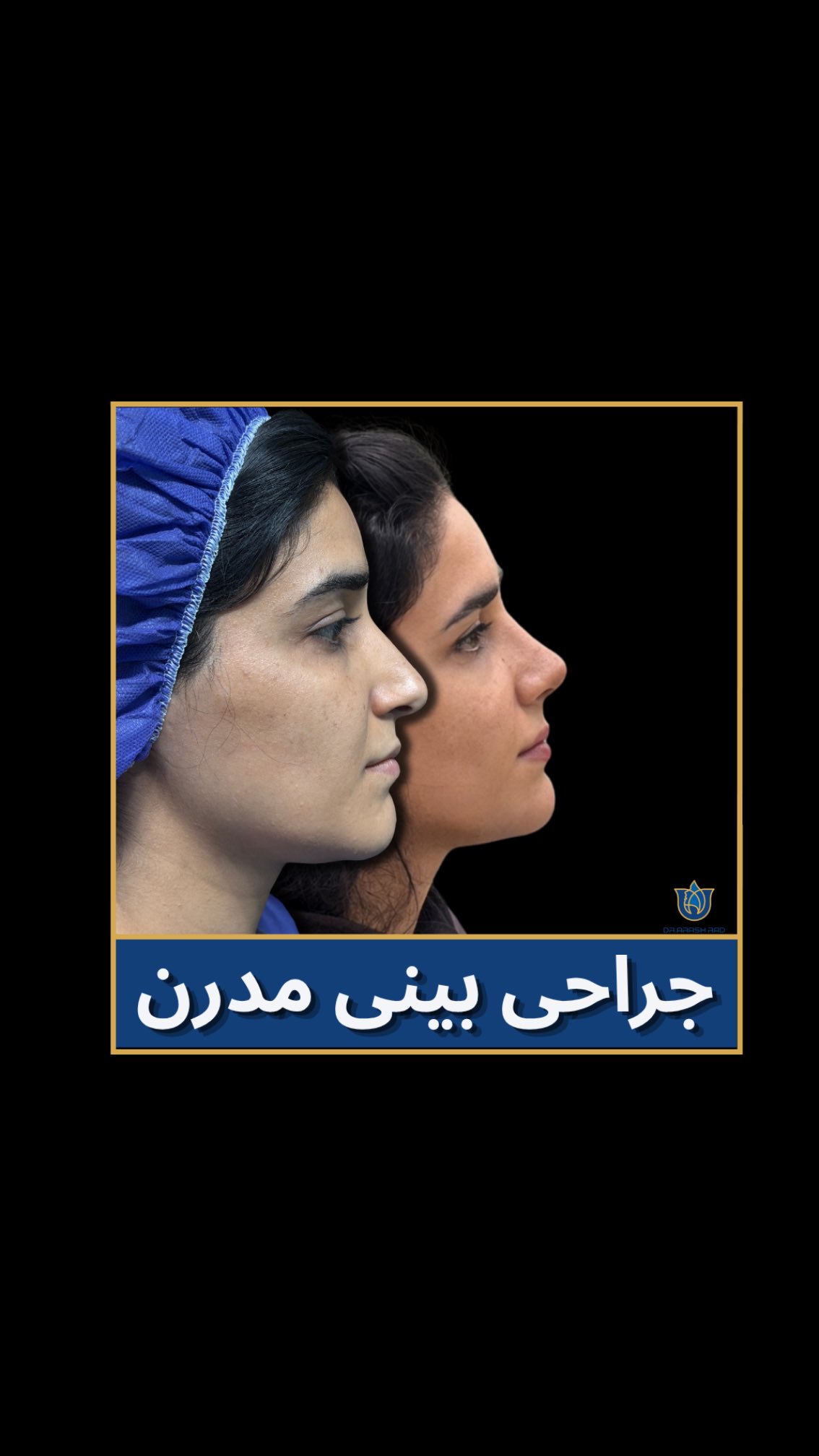 مقایسه نیمرخ پیش و پس از جراحی بینی با فرم طبیعی