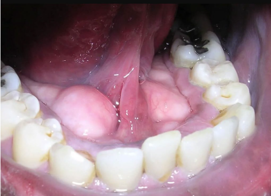جراحی ضایعات دهان؛ درمان توده‌ها و تغییرات غیرطبیعی