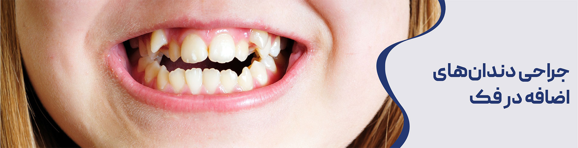 جراهی teeth added in the jaw