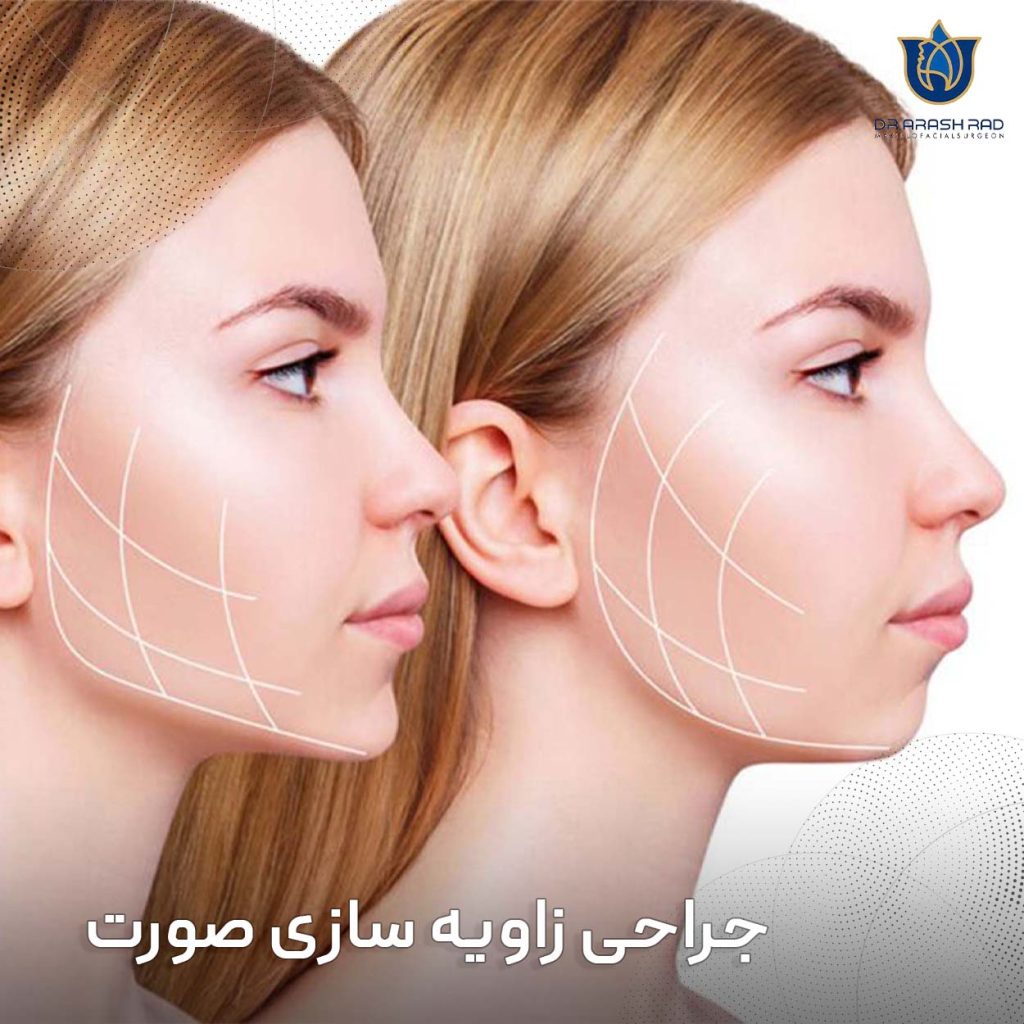 جراحی زاویه سازی فک