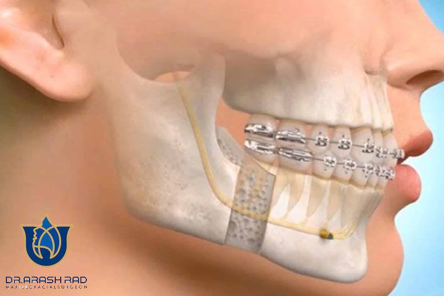 هزینه های جراحی فک توسط دکتر مانی آرش راد