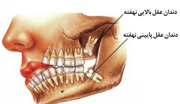 جراحی دندان عقل