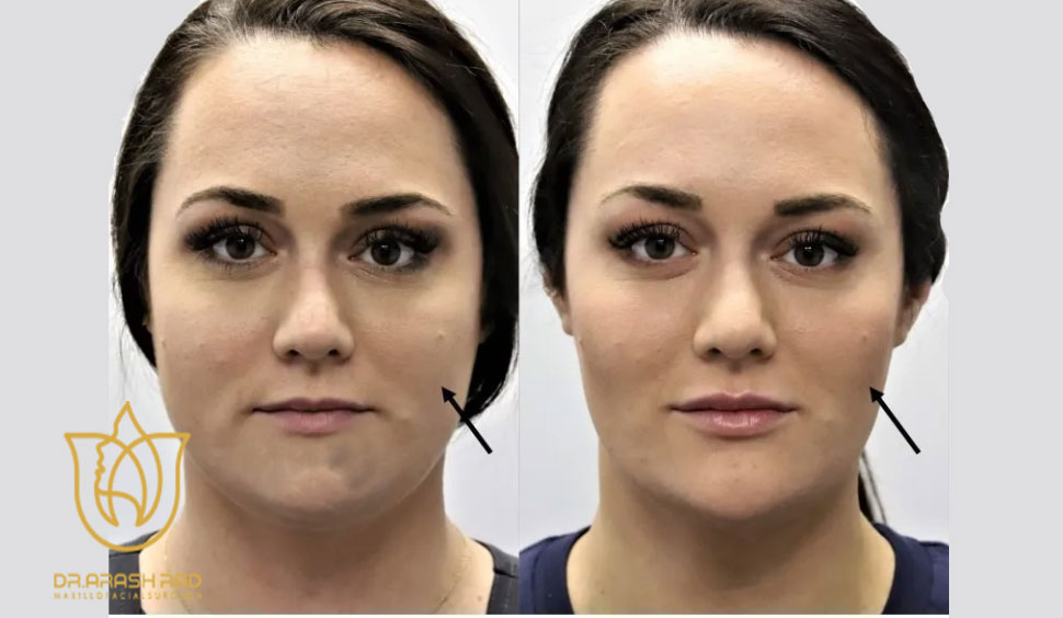 رفع تورم بوکال فت