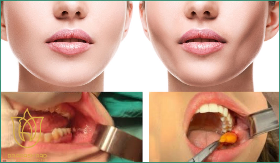 نحوه جراحی بوکال فت