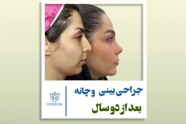 پروتز چانه