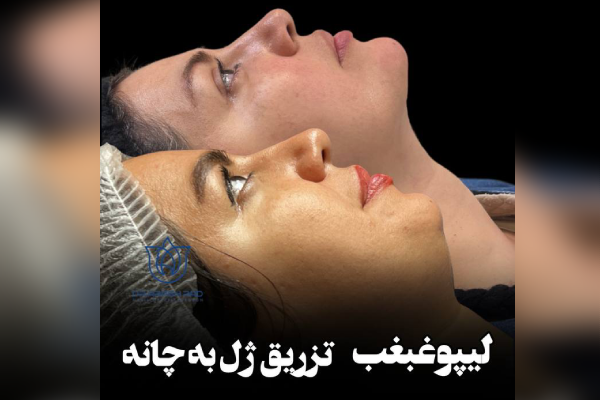 تزریق ژل به چانه