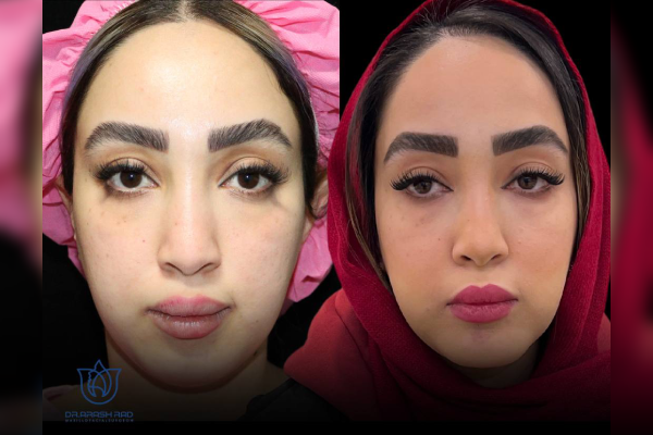 جراحی چانه یا ژنیوپلاستی