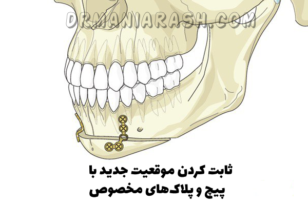 جراحی چانه یا ژنیوپلاستی 
