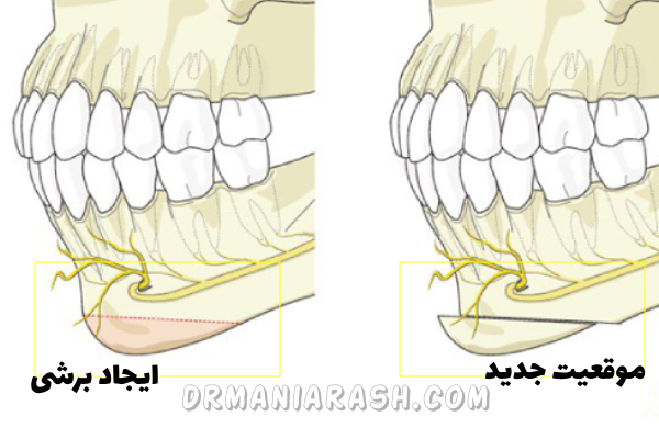 جراحی چانه یا ژنیوپلاستی