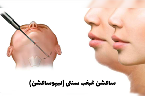 ساکشن غبغب