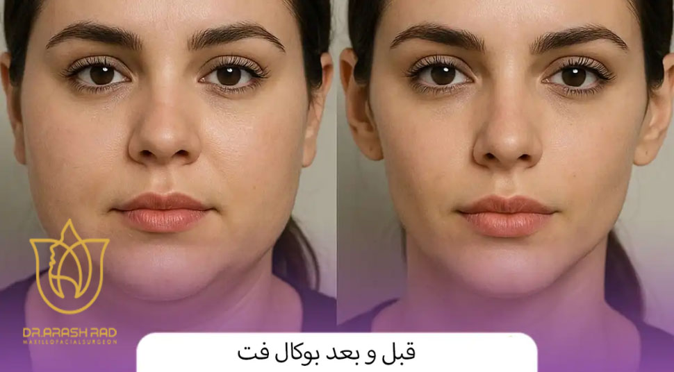 نتایج نهایی عمل بوکال فت