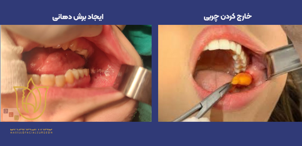 مراحل انجام بوکال فت