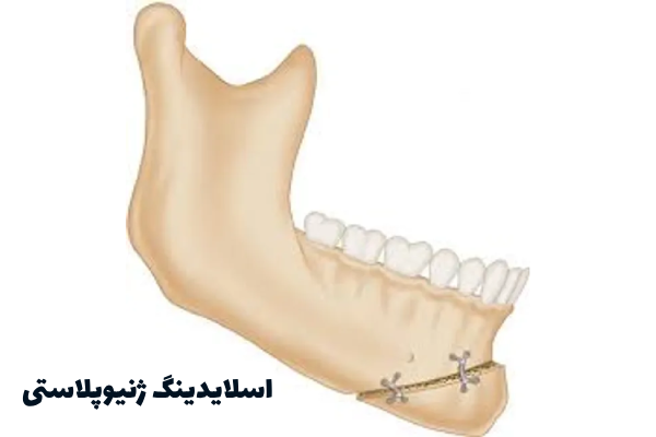 جنيوپلاستی