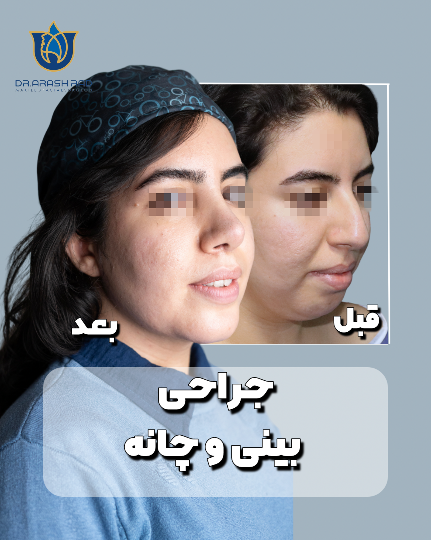 جراحی چانه ژنیوپلاستی