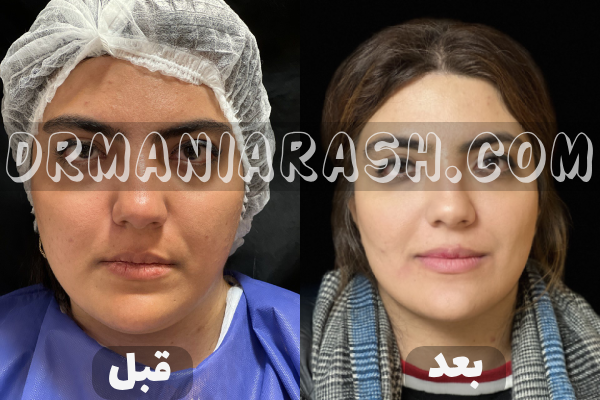 حذف چربی بوکال