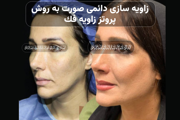 زاویه سازی صورت