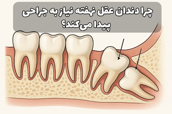 جراحي دندان عقل نهفته