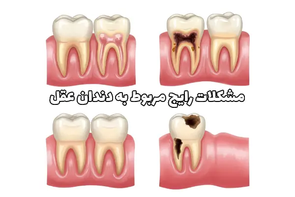 جراحی دندان عقل