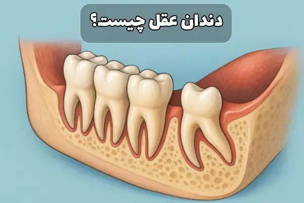 جراحی دندان عقل