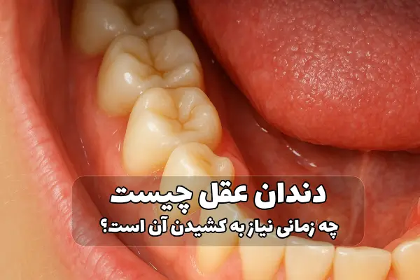 كشيدن دندان عقل