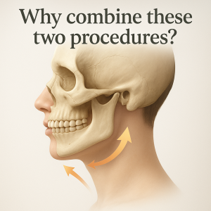 combining V-line with chin augmentation