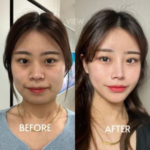 3D planning and imaging for precise V-line results