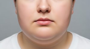double chin fat vs sagging skin
