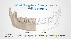 long-term results and maintenance