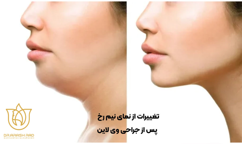 تغییرات از نمای نیمرخ پس از جراحی V-Line