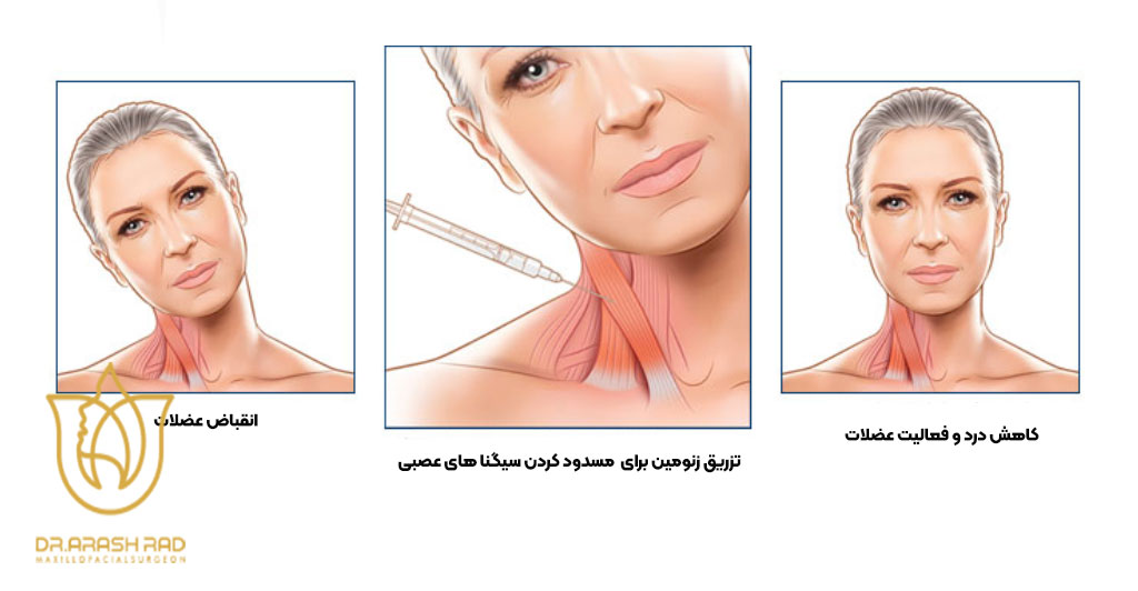 مزایای بوتاکس درمانی
