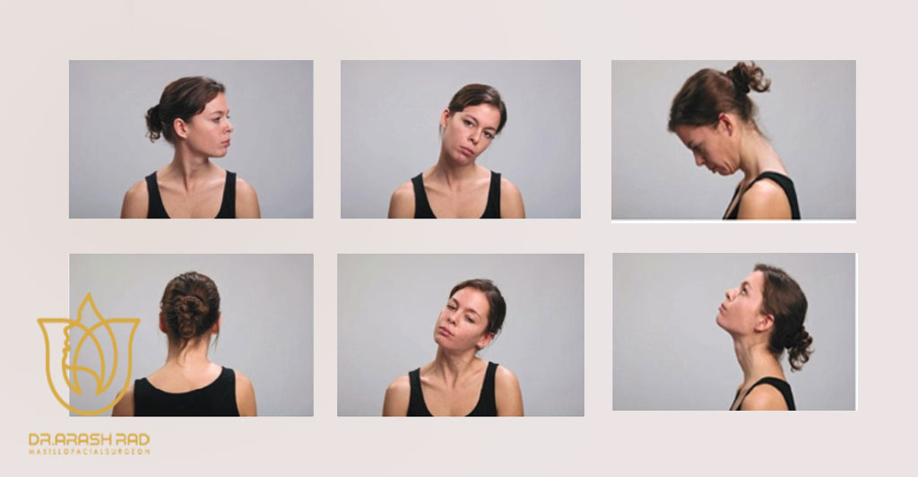 تورتیکولی: شایعترین نوع دیستونی گردنی