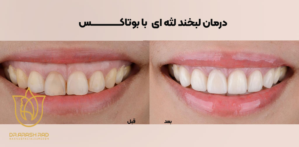 بوتاکس لبخند لثه ‌ای 