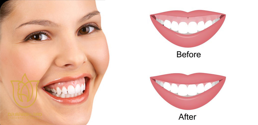 لبخند لثه‌ای چیست 