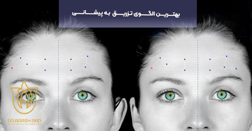 بهترین الگوی تزریق بوتاکس به پیشانی