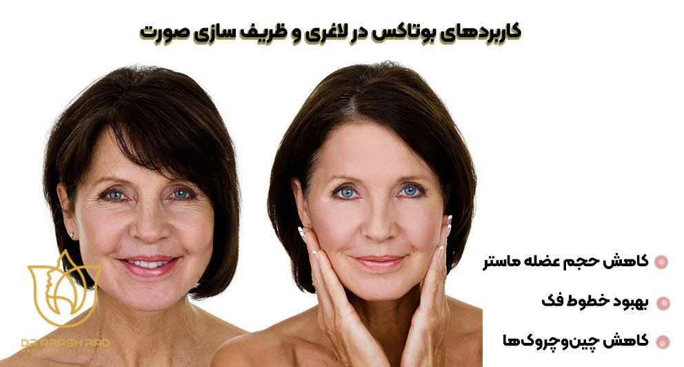 کاربردهای بوتاکس در لاغری صورت