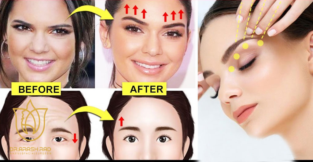 تاثیر تزریق بوتاکس برای لیفت ابرو