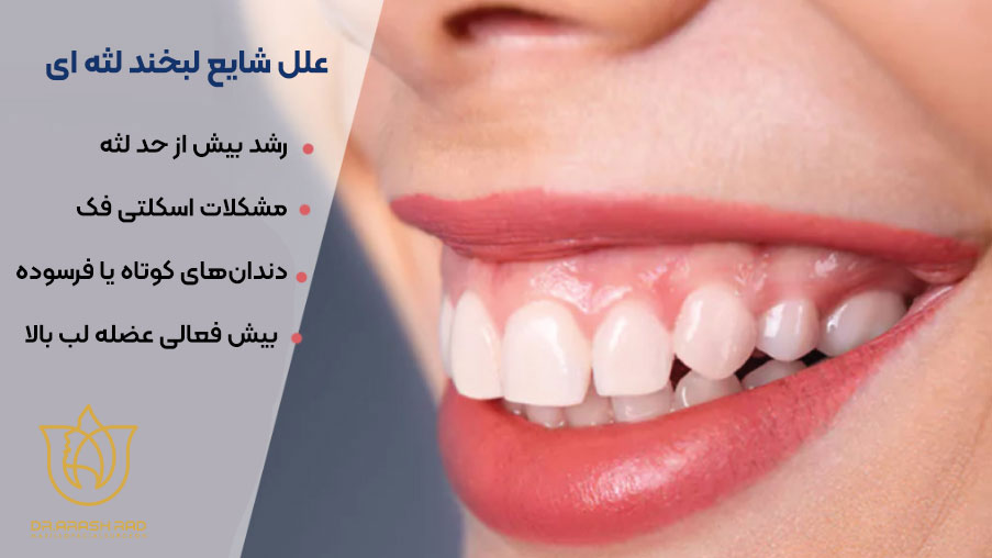 علل شایع لبخند لثهای