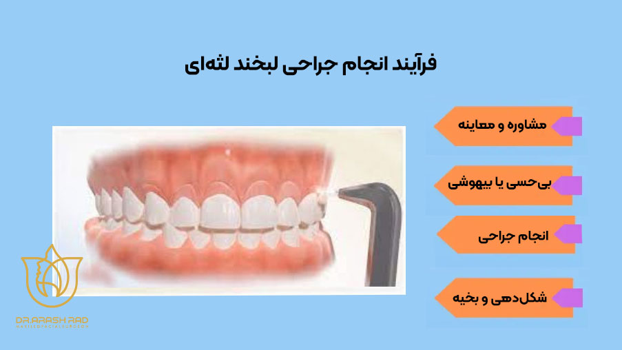 فرآیندجراحی لبخند لثهای