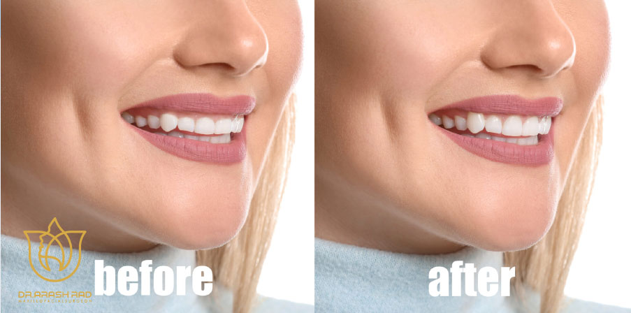 تغییرات چهره بعد از جراحی لبخند لثه ای