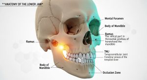 Mandibular setback surgery