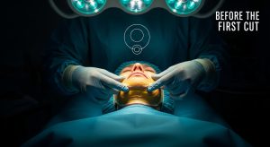 chin augmentation osteotomy