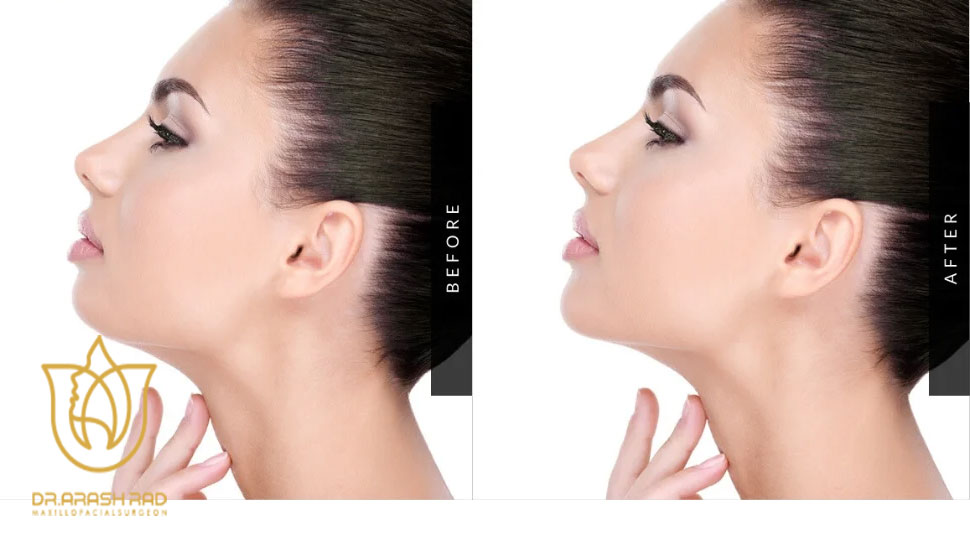 دلایل انجام پروتز چانه