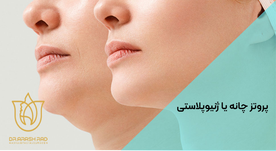 پروتز چانه یا ژنیوپلاستی